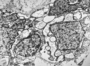 F,12y. | malignant tumor of the orbita - liposarcoma?, neurofibrosarcoma?